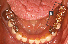 治療後のお口の中の状態（下顎）